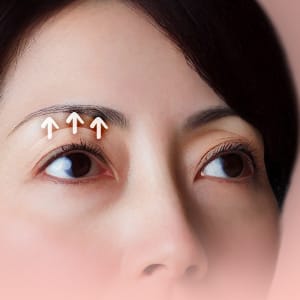 まぶたリフト（切らないまぶたのたるみ取り）【画像】
