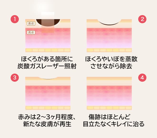 ①ほくろがある箇所に炭酸ガスレーザー照射 ②ほくろやいぼを蒸散させながら除去 ③赤みは2~3ヶ月程度、新たな皮膚が再生 ④傷跡はほとんど目立たなくキレイに治る