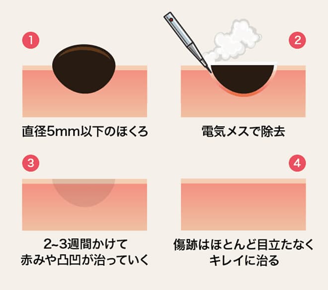 ①直径5mm以下のほくろ ②電気メスで除去 ③2~3週間かけて赤みや凸凹が治っていく ④傷跡はほとんど目立たなくキレイに治る