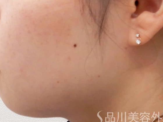 一般的なほくろ(母斑細胞性)のイメージ