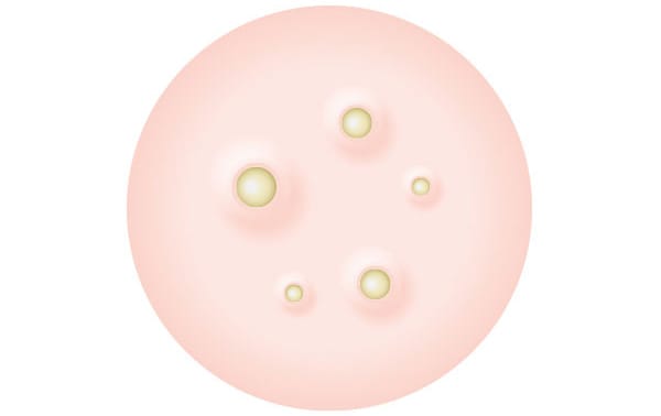 白いニキビ【画像】