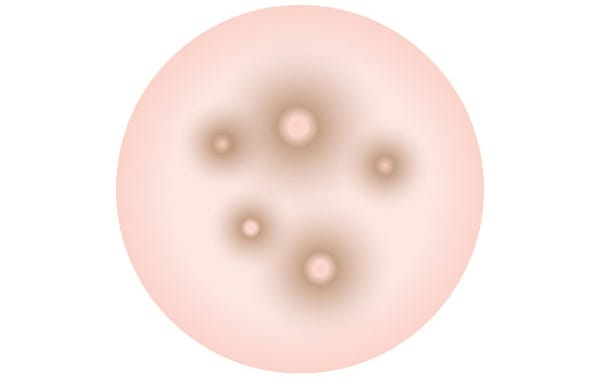 茶色いニキビ【画像】
