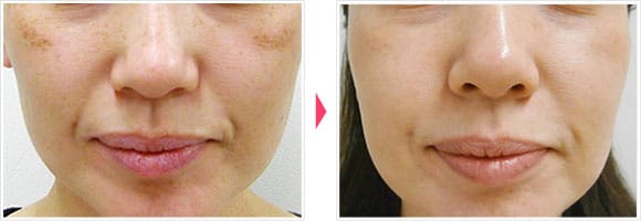 レーザートーニング 症例写真 Before After【画像】