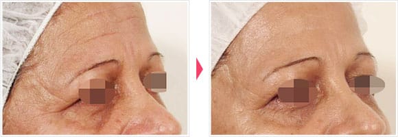 オキシジェネオ(Oxy Geneo) 症例写真 Before After【画像】