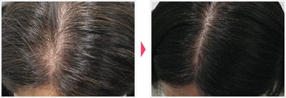 メディカル髪育注射 症例写真 Before After【画像】