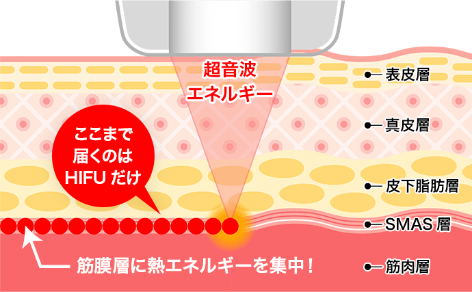 筋膜層に熱エネルギーを集中【画像】