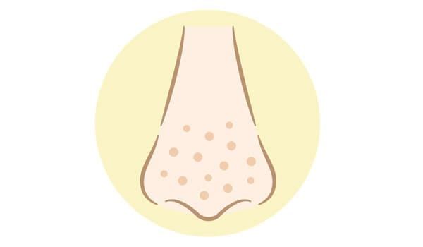 メラニン色素の色素沈着によるいちご鼻【画像】