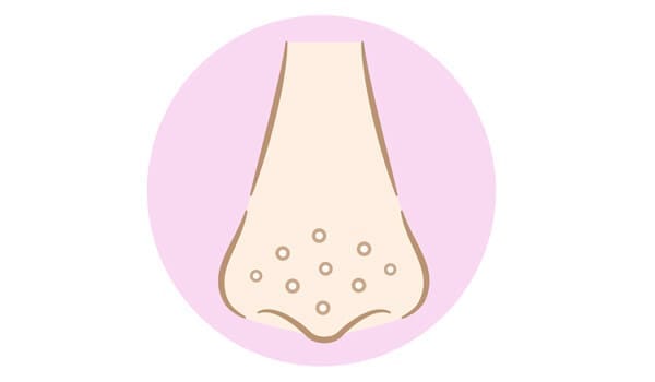 毛穴の開きや産毛がいちご鼻に見える場合も!【画像】