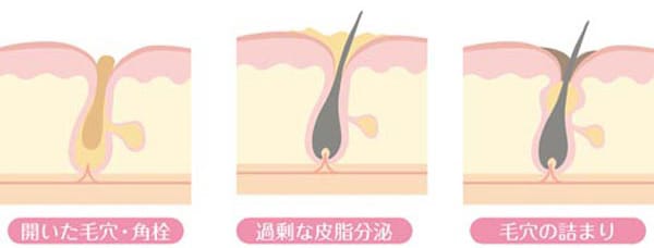 毛穴の開き(開き毛穴)の原因【画像】