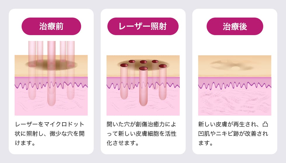 治療前:レーザーをマイクロドット状に照射し、微小な穴を開けます。レーザー照射:開いた穴が創傷治癒力によって新しい皮膚細胞を活性化させます。治療後:新しい皮膚が再生され、凸凹肌やニキビ跡が改善されます。