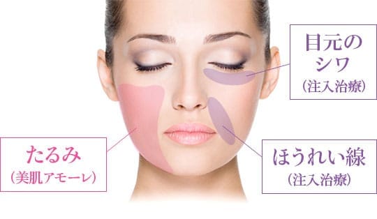 たるみ（美肌アモーレ）目元のシワ（注入治療）ほうれい線（注入治療）