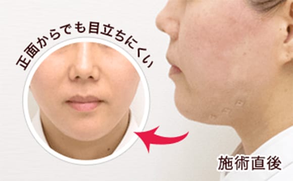 腫れや治療跡は極力少なく