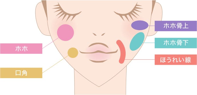 うるおい注射®の対象部位 ホホ 口角 ホホ骨上 ホホ骨下 ほうれい線【画像】