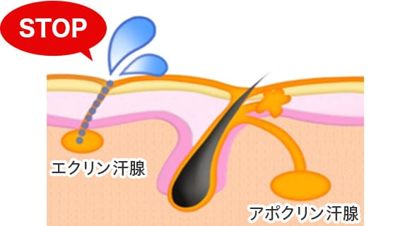 ボツリヌス注射をワキの皮膚の浅い部分に注入し、エクリン汗腺の神経に働きかけ、汗の分泌を弱めることができます。