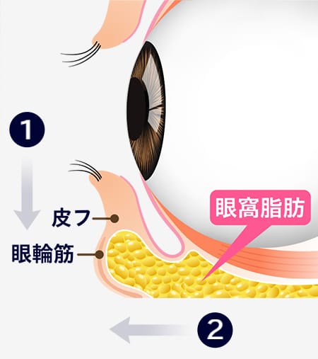 皮フ 眼輪筋 眼窩脂肪【画像】