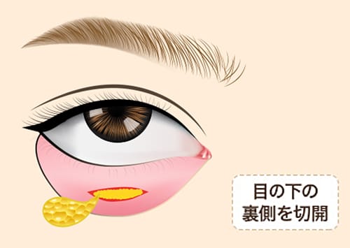 目の下の裏側を切開【画像】