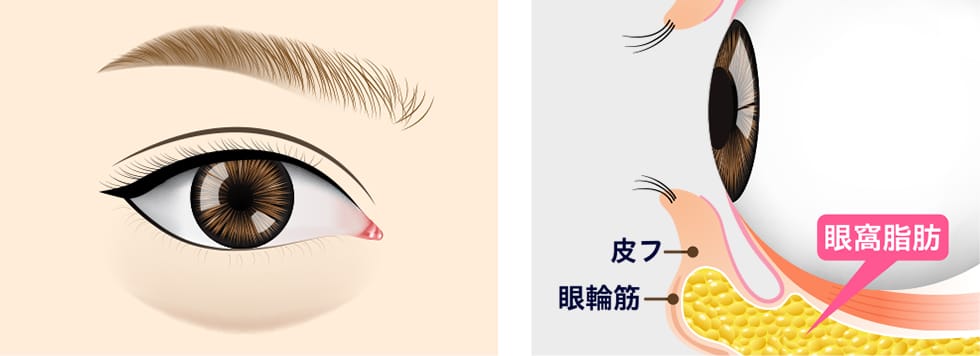 下まぶたをめくり眼窩脂肪を確認【画像】