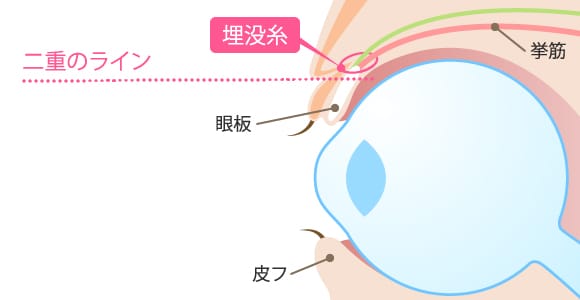 二重術スーパークイック法(埋没法)術 眼球断面図【画像】