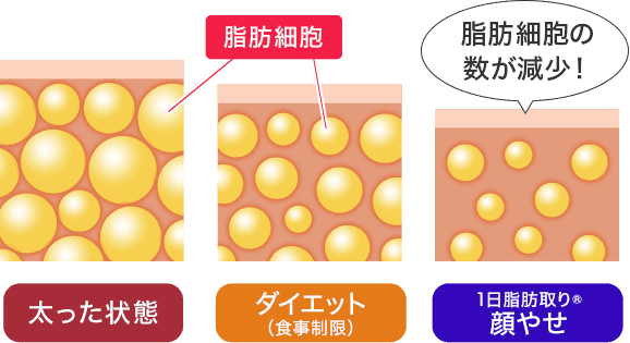 脂肪細胞は太った状態よりもダイエット(食事制限)時のほうが少なく、それよりも1日脂肪取り® 顔やせのほうが少ないです
