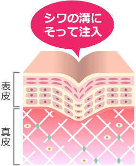シワのある肌 シワの溝にそって注入