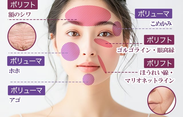 ボリフト:額のシワ・ゴルゴライン・眼窩縁 ボリューマ:こめかみ・ホホ・アゴ