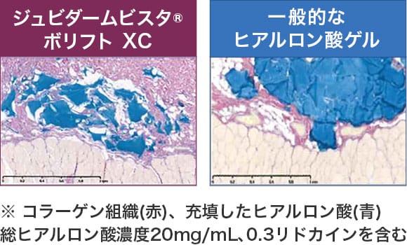 【ジュビダームビスタ®ボリフトXC】【一般的なヒアルロン酸ゲル】※コラーゲン組織（赤）、充填したヒアルロン酸（青）総ヒアルロン酸濃度20mg/ｍL、0.3リドカインを含む