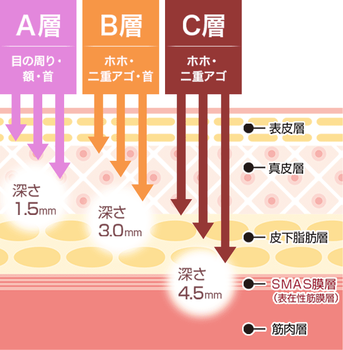 A層（目の周り・額・首）即効性を感じやすい肌表面まで届く、B層（ホホ・二重アゴ・首）たるみの原因となる真皮層まで届く、C層（ホホ・二重アゴ）皮膚を支える土台であるSMAS層まで届く