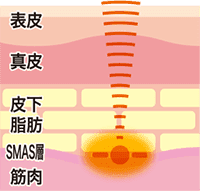 線状方式
