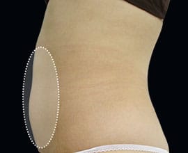 クールスカルプティング®：脂肪を冷却して破壊する痩身術。治療部位6【画像】