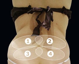 クールスカルプティング®：脂肪を冷却して破壊する痩身術。治療部位7【画像】