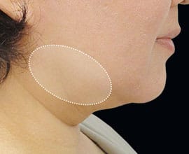 クールスカルプティング®：脂肪を冷却して破壊する痩身術。治療部位11【画像】