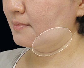 クールスカルプティング®：脂肪を冷却して破壊する痩身術。治療部位12【画像】