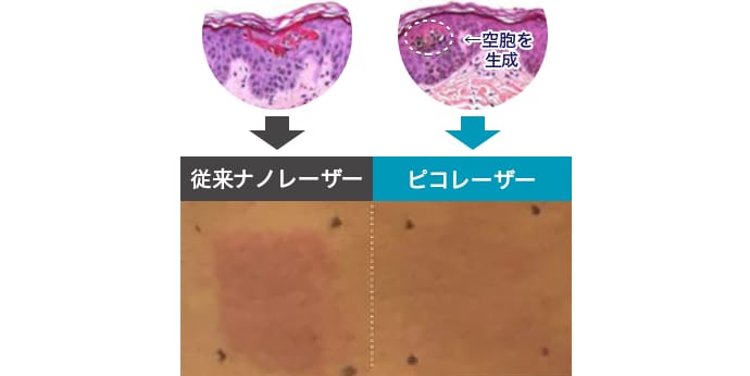 レーザー照射後の色素沈着のリスクが少ない【画像】