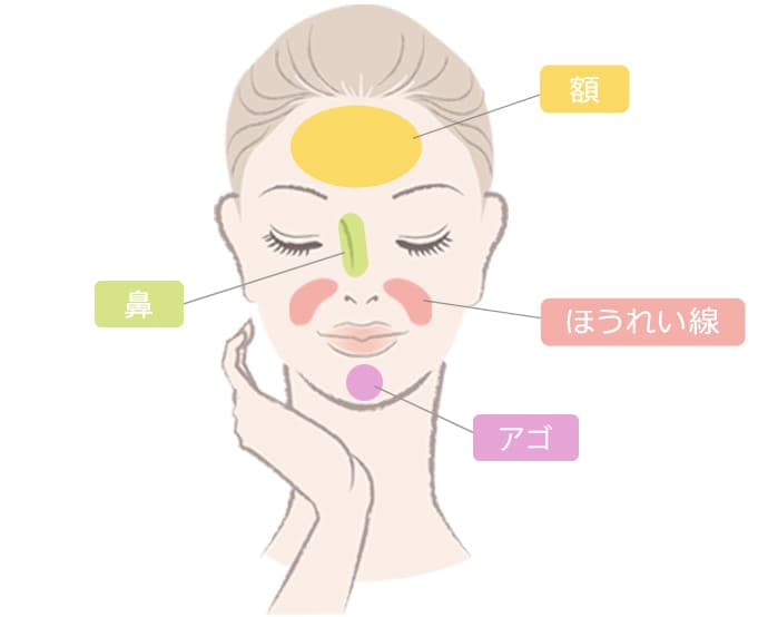 ヒアルロン酸 レスチレン®リドの処置部位：額・ほうれい線・鼻・アゴ【画像】