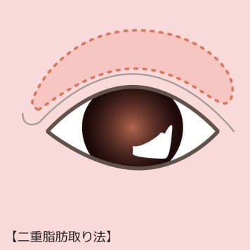二重脂肪取り法【画像】