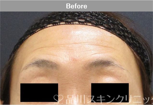 アラガン社製ボツリヌス注射×美肌注射 症例写真 Before