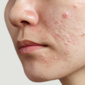 表参道院のニキビ跡治療