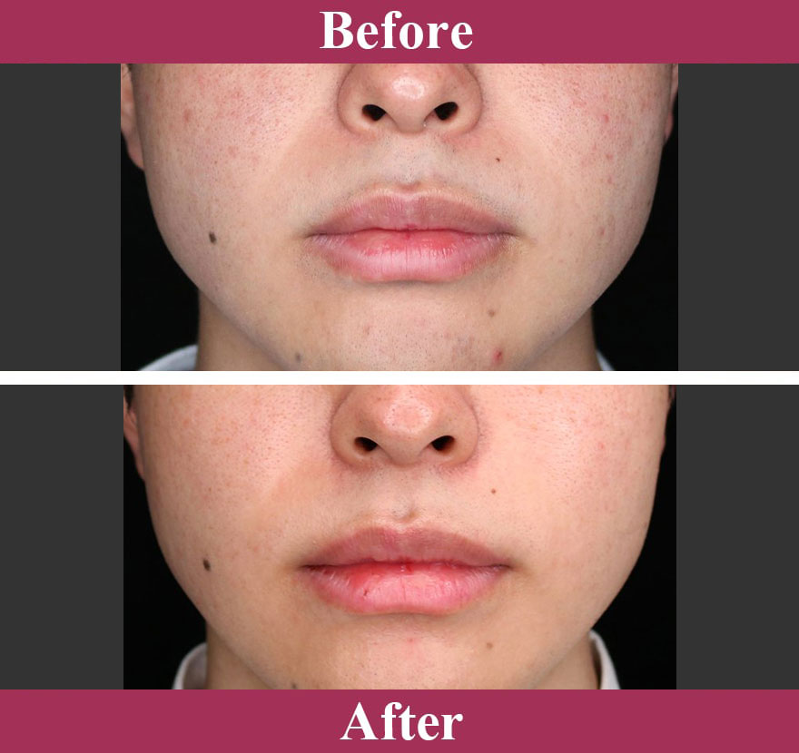 ポテンツァ 症例写真【画像】