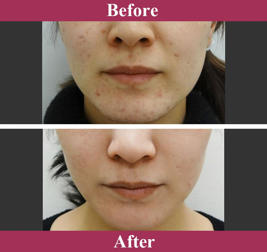 フォトシルクプラス 症例写真【画像】