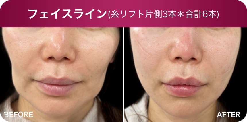 フェイスライン（糸リフト片側3本）＊合計6本