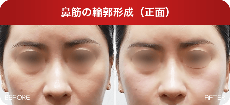 鼻筋の輪郭形成(正面) Before & After