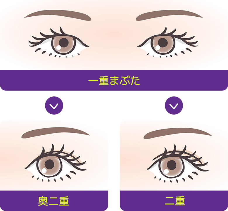一重まぶた / 奥二重 / 二重