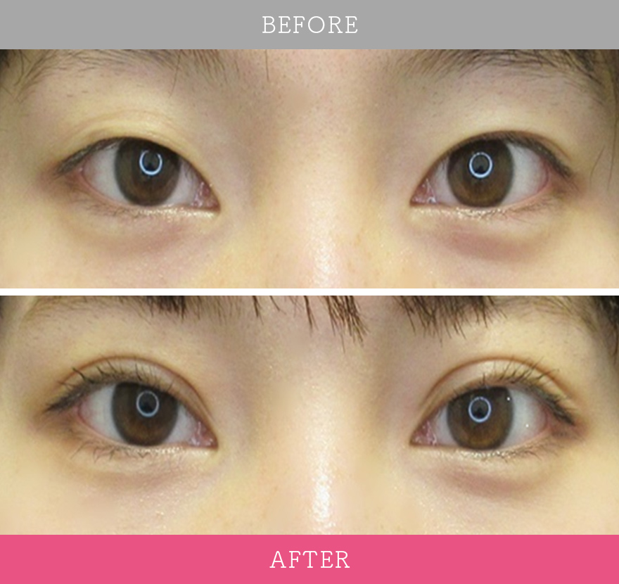 二重術エバーナチュラル法 症例写真