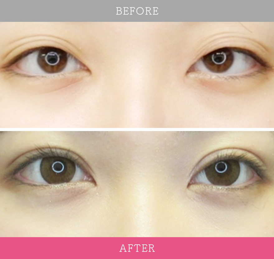 二重術エバーナチュラル法 症例写真