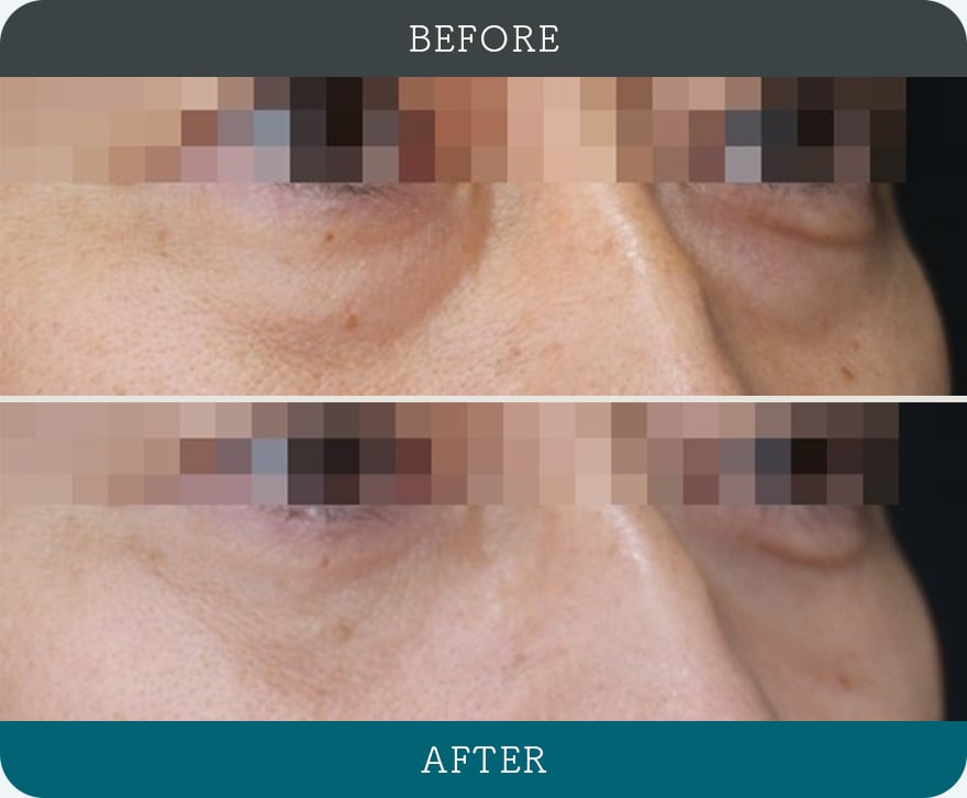 切らないクマ取り 症例写真