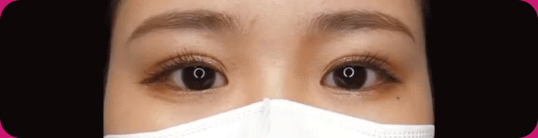 当院一番人気の埋没法！