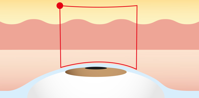 線留め方式（二重術エバーナチュラル法）