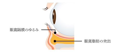 下まぶたのたるみの原因