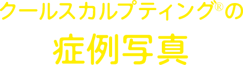 クールスカルプティング®のビフォーアフター