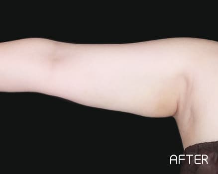 クールスカルプティング®の症例写真 After